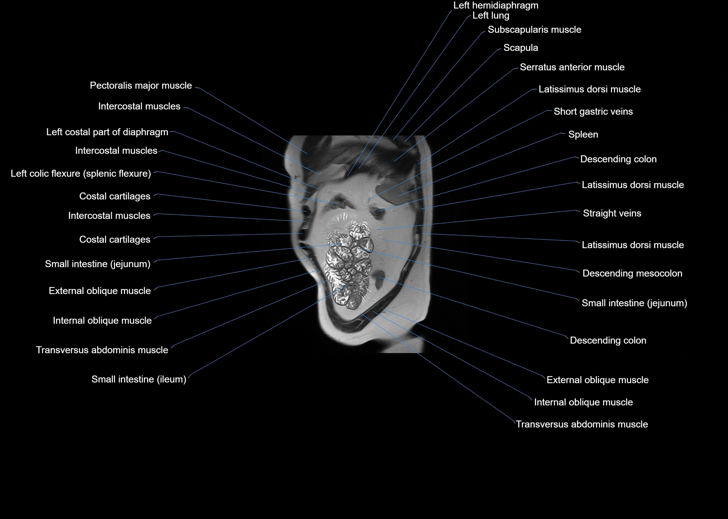 MRI abdomen sagittal cross sectional anatomy  radiology  image-img-00001-00060.webp